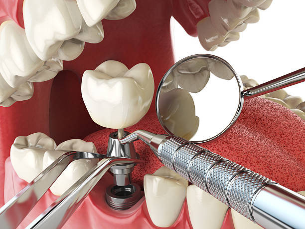 Best Emergency Treatment for Oral Infections in Royal Oak, MI